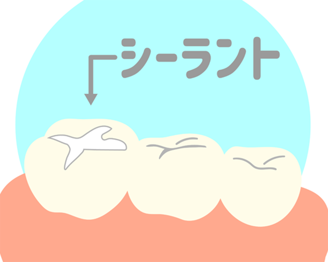 歯の溝を滑らかにして、むし歯になりにくくする